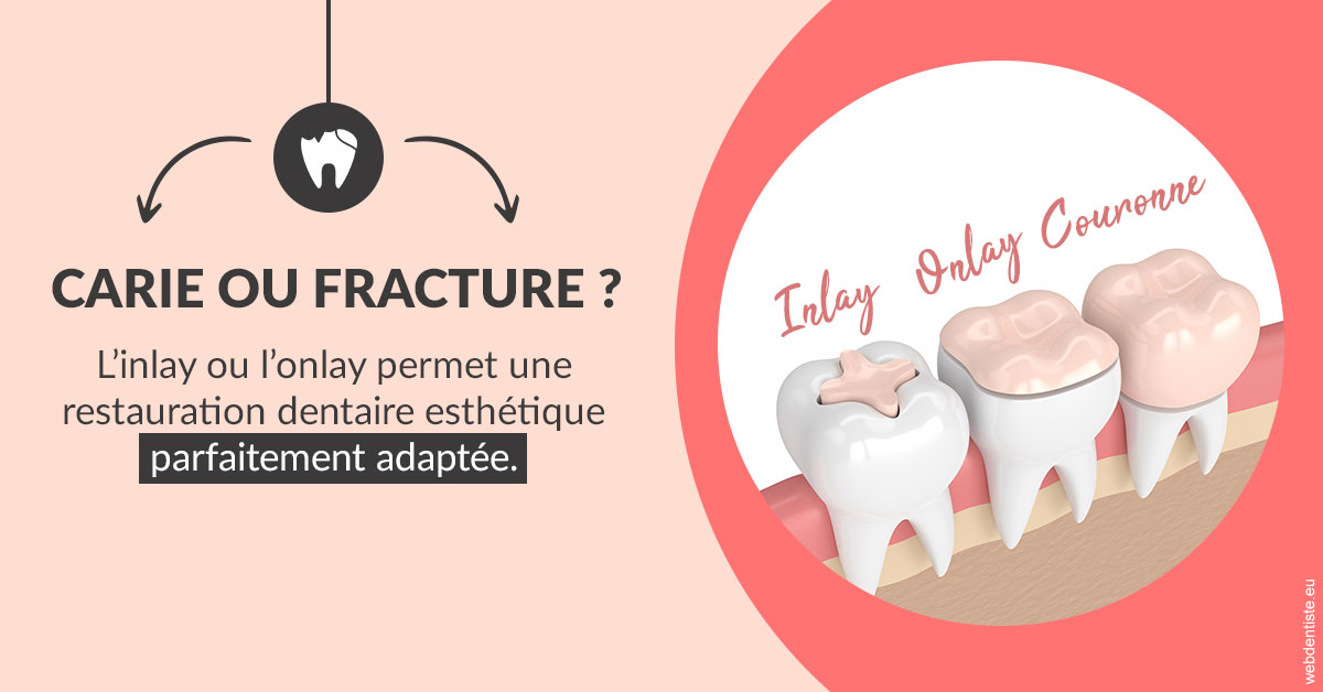 https://dr-laurence-choukroun-de-boerdere.chirurgiens-dentistes.fr/T2 2023 - Carie ou fracture 2
