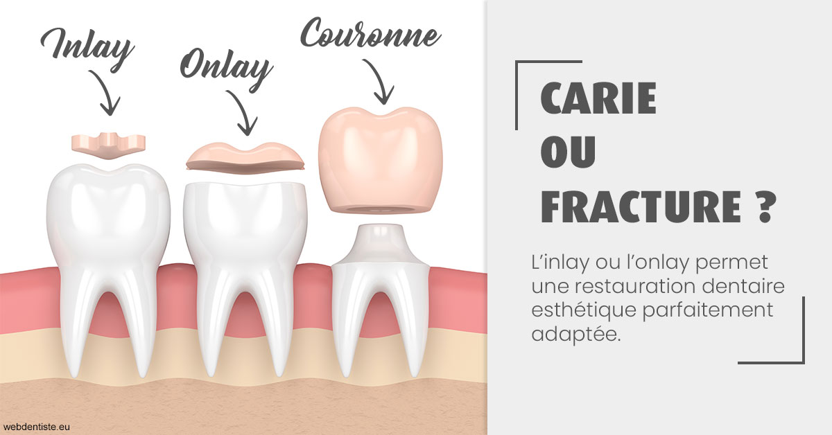 https://dr-laurence-choukroun-de-boerdere.chirurgiens-dentistes.fr/T2 2023 - Carie ou fracture 1