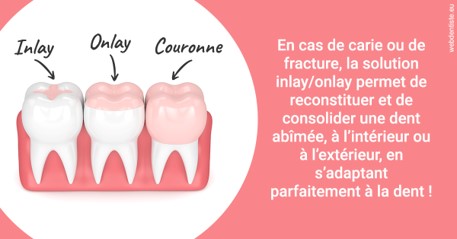 https://dr-laurence-choukroun-de-boerdere.chirurgiens-dentistes.fr/L'INLAY ou l'ONLAY 2