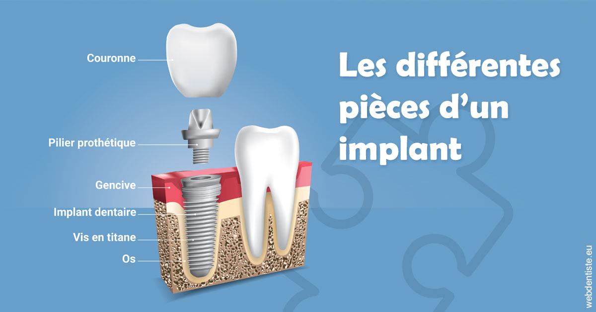 https://dr-laurence-choukroun-de-boerdere.chirurgiens-dentistes.fr/Les différentes pièces d’un implant 1